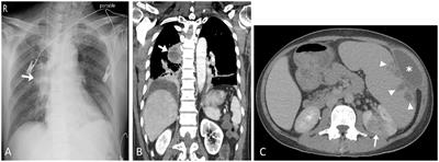 Endemic melioidosis in central Taiwan—A longitudinal case cohort study